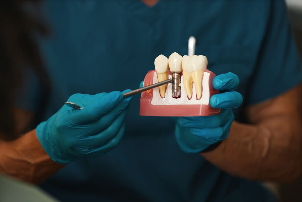 implants