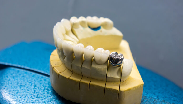 Sample Prosthodontic on blue steel surface.