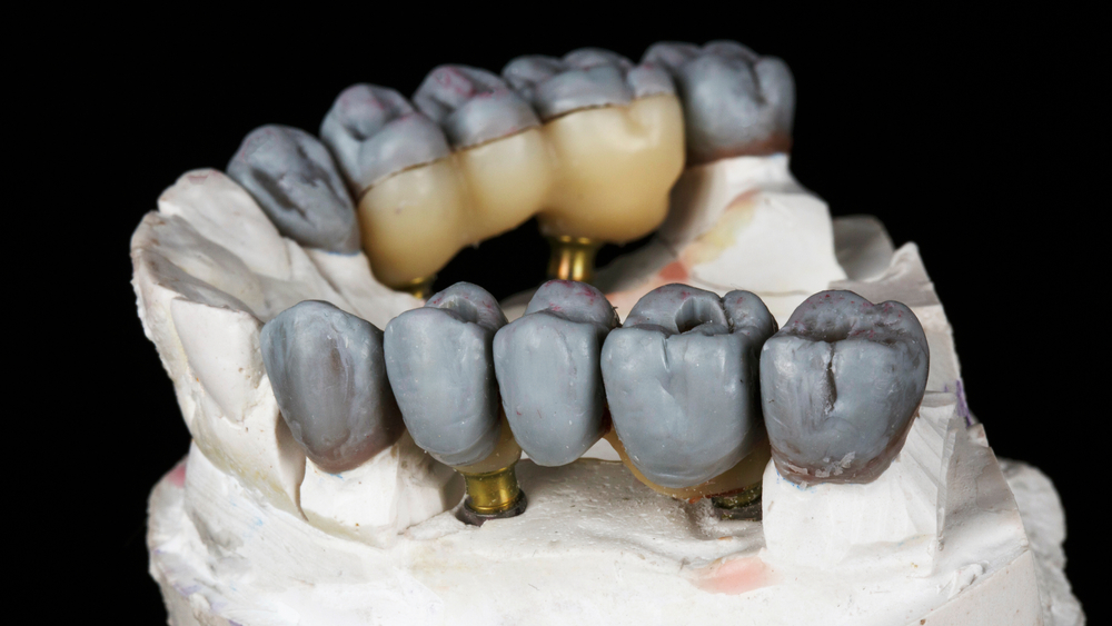 fitting wax crowns on the model to create the final product