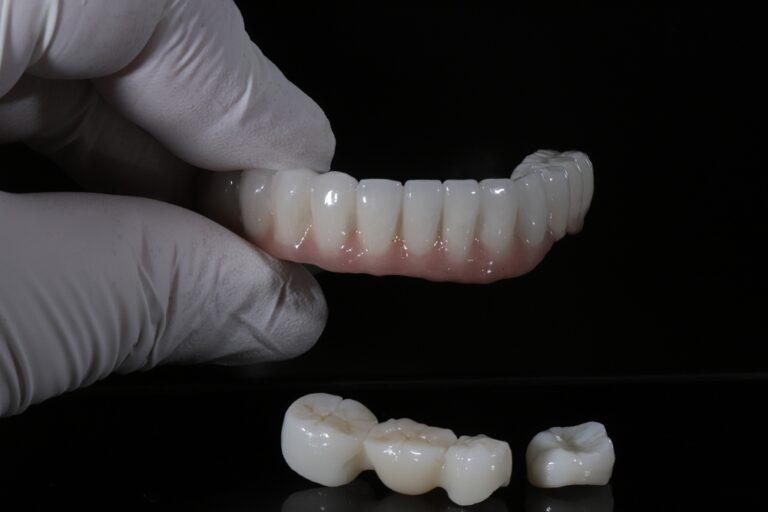 Glass-ceramic porcelain laminate veneers and zirconium crown bridge prostheses applied in dental dentistry to restore aesthetics and chewing function.