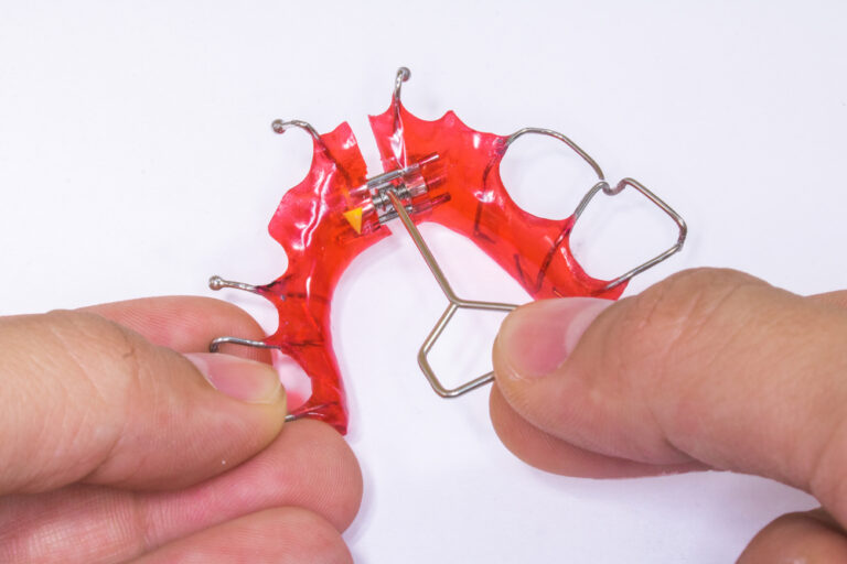 Hands on demonstration on using a special key to activate the expansion screw of a removable orthodontic appliance to separate the two halves.
