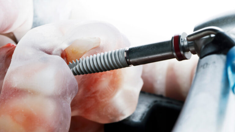 dental implant and surgical template for patient installation