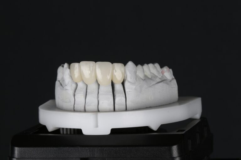 Glass ceramic or zirconium porcelain crowns. Dental bridge crown treatment.Aesthetic smile design treatment in dental dentistry.