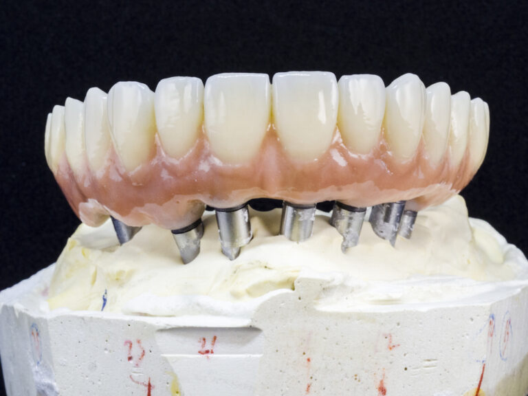 Monolithic zirconia restorations full arch implant supported with the ceramic load in vestibular, back background.