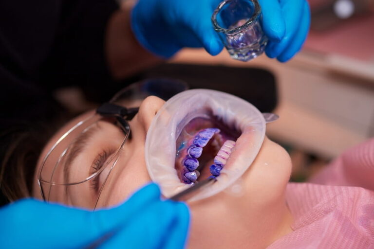 Plaque indicator on human teeth with braces. Plaque is colored pink. Teenager using plaque indicator gel.