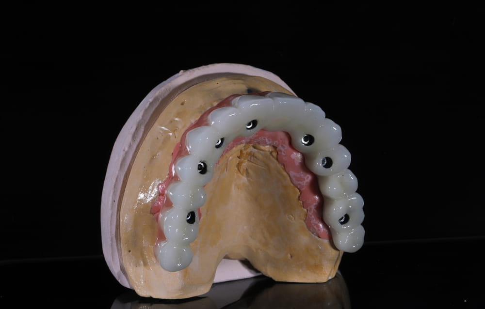 Full-arch dental prosthesis with implant treatment in dentistry. Full-arch porcelain dental prosthesis with metal bar known as implant-supported hybrid prosthesis.