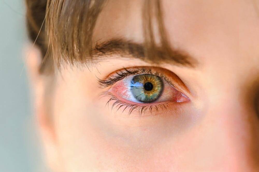 Green eyes of a teenager inflamed and with red veins, like with pink-eye