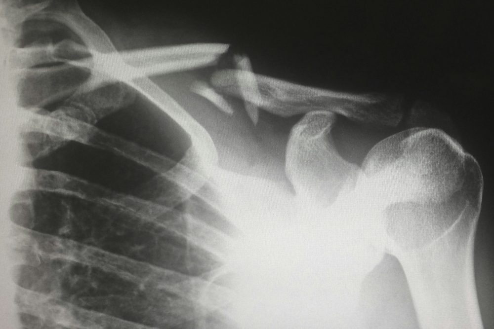 X-ray image of clavicle