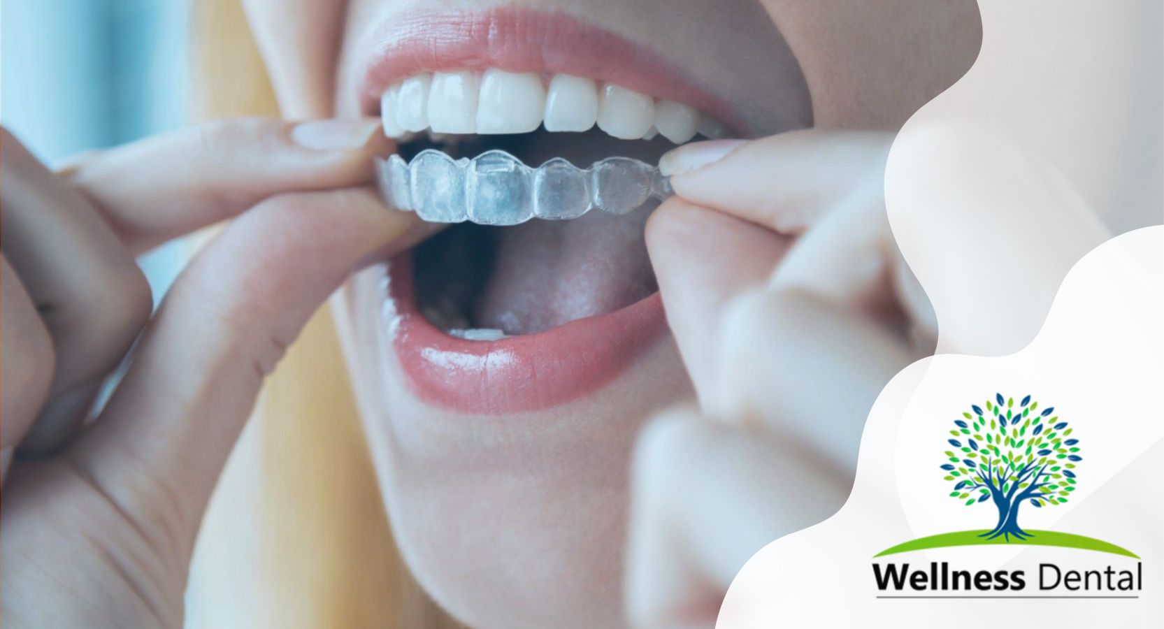 How Does Invisalign Work: A Comprehensive Guide to Straightening Teeth