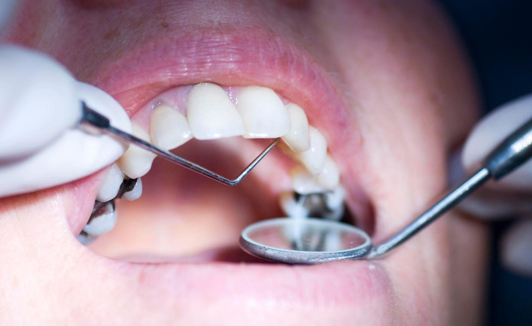 Cavities Genetic