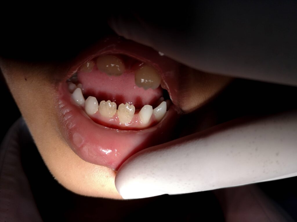 Mamelons on lower incisor teeth