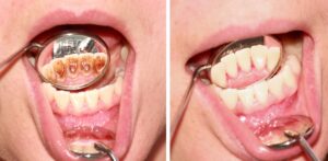 Before and after removal of tartar. Reflection in the mirror