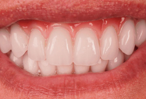 Cosmetic bonding - 1 - After