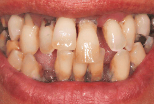 Cosmetic bonding - 1 - Before