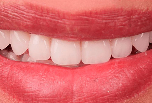 Cosmetic bonding - 2 - After