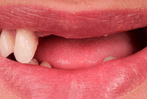 Cosmetic bonding - 2 - Before
