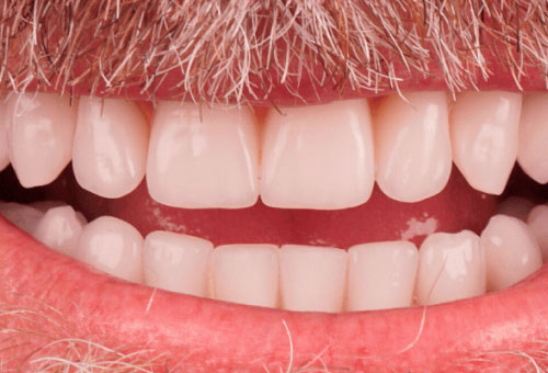 Cosmetic bonding - 3 - After
