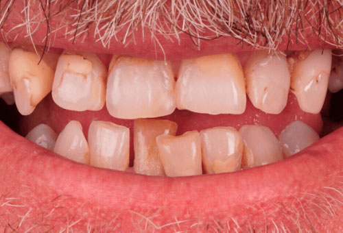 Cosmetic bonding - 3 - Before