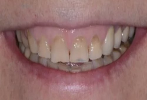 Crowns - 5 - Before