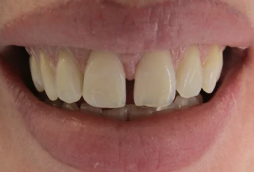 Crowns - 6 - Before