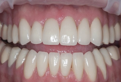 Crowns - 8 - After