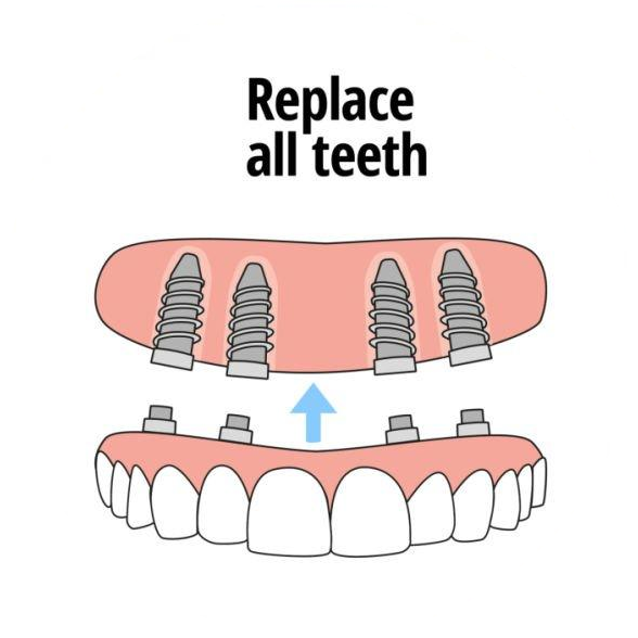 Full-Mouth-Implant