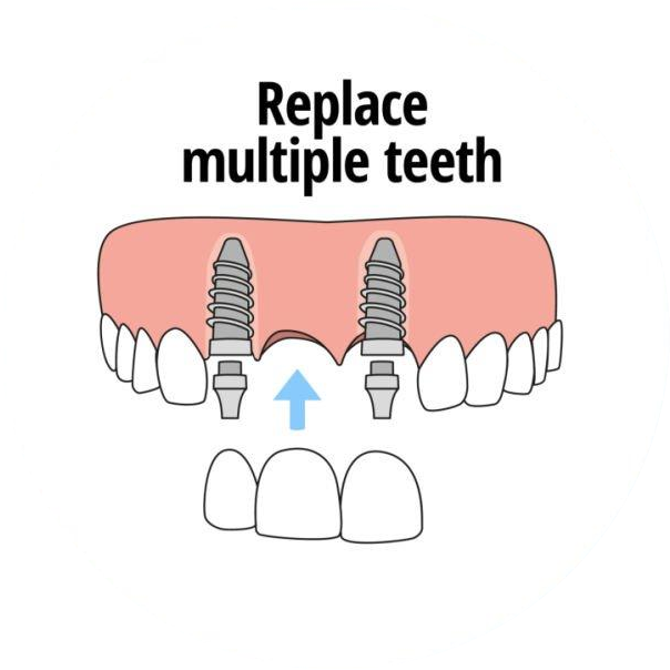 Multiple-ToothImplant