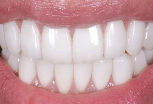 Porcelain Veneers - 1 - After