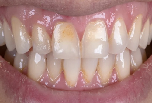 Porcelain Veneers - 1 - Before