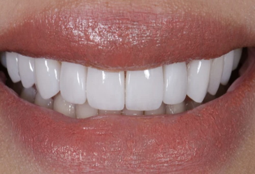 Porcelain Veneers - 2 - After