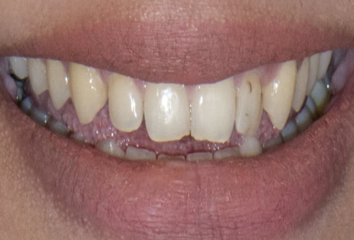 Porcelain Veneers - 2 - Before