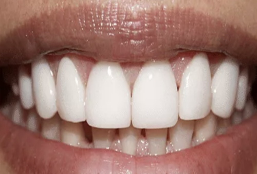Porcelain Veneers - 3 - After