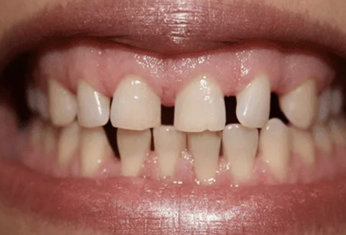 Porcelain Veneers - 3 - Before