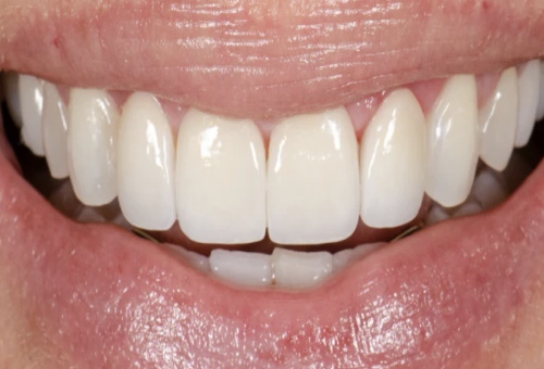 Porcelain Veneers - 4 - After