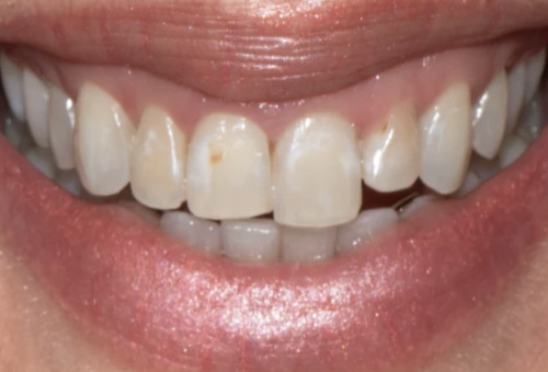 Porcelain Veneers - 4 - Before