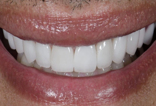 Porcelain Veneers - 5 - After