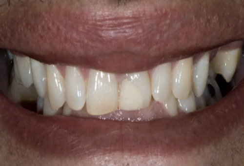 Porcelain Veneers - 5 - Before