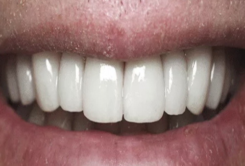 Porcelain Veneers - 6 - After