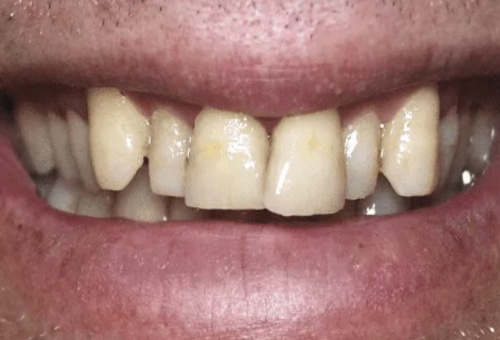 Porcelain Veneers - 6 - Before