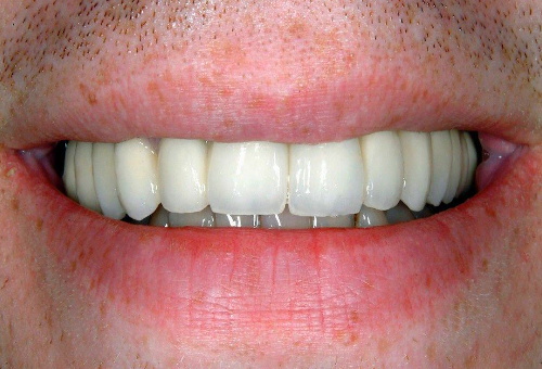 Porcelain Veneers - 7 - After