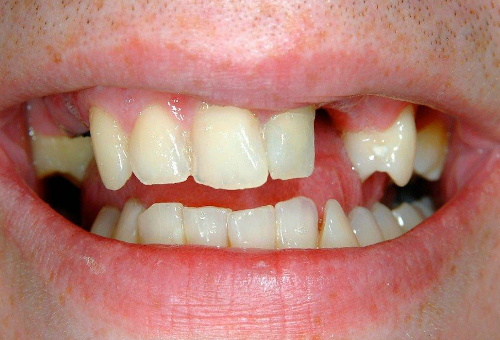 Porcelain Veneers - 7 - Before