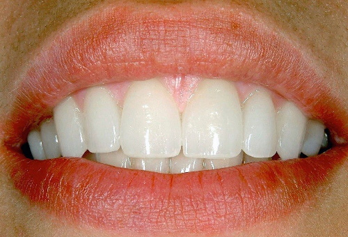 Porcelain Veneers - 8 - After