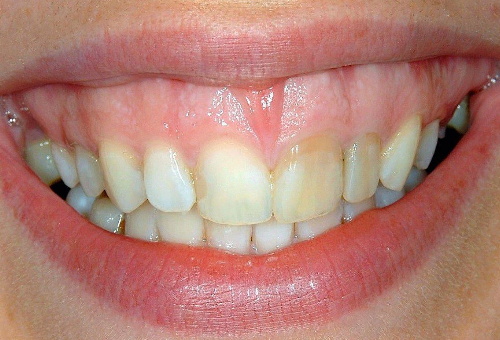 Porcelain Veneers - 8 - Before