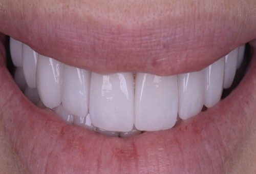 Porcelain Veneers - 9 - After