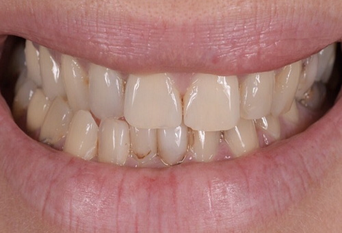 Porcelain Veneers - 9 - Before