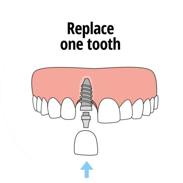 Single-Tooth-Implant