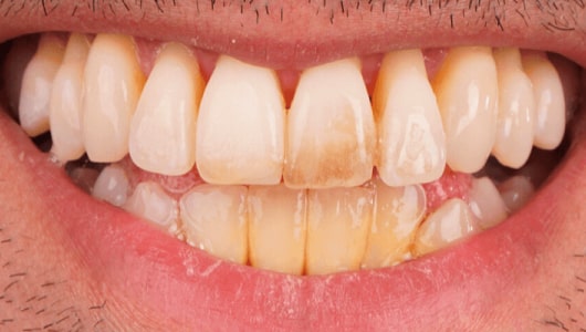 veneers_slide_1-min