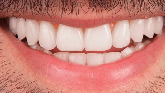 veneers_slide_2-min