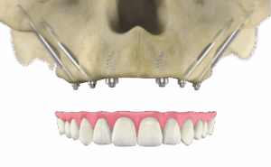 Zygomatic implants