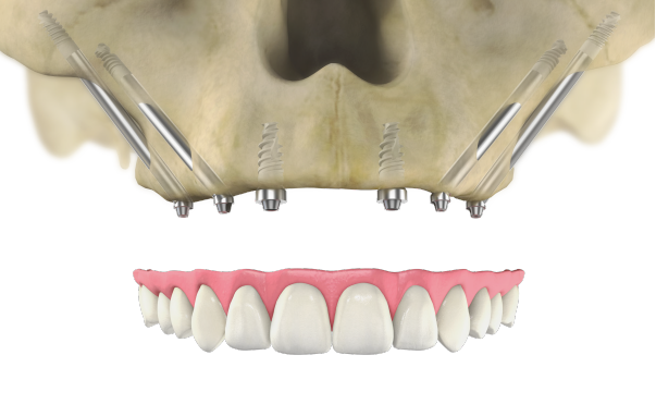 Zygomatic implants